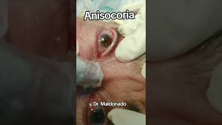 ANISOCORIA medicina seguridad ciencia sabiasque emergency curiosidades tratamientos [upl. by Imaon]