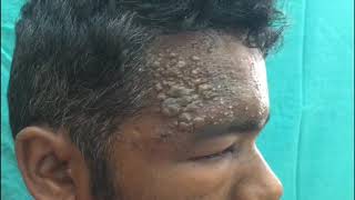 Case of Herpes zoster ophthalmicus [upl. by Don]