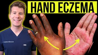 Doctor explains how to recognise and treat HAND ECZEMA dermatitis  Causes symptoms amp prevention [upl. by Anawak169]