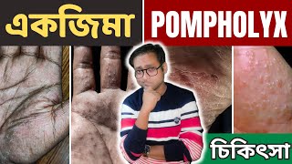 Dyshidrotic eczema  Pompholyx  চিকিৎসা  Dr Supratim Saha [upl. by Nirok]