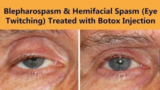 Botox Injection for Blepharospasm amp Hemifacial Spasm Eyelid Twitching  The Esthetic Clinics [upl. by Soll]