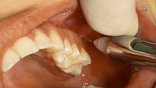 Técnica de la Tuberosidad o para el Nervio Alveolar Superior Posterior [upl. by Fairleigh]