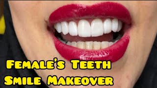 Zoom Teeth Camera teethmakeover [upl. by Sibbie]