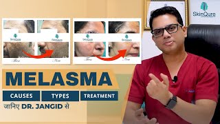 All About Melasma  Causes Types and Treatment options  जानिए Dr Jangid से हिंदी में  SkinQure [upl. by Nitaf127]