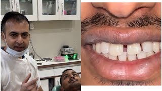 Mid line diastema  teeth gap closure दातों के बीच के गेप्स को भरना [upl. by Nojid804]