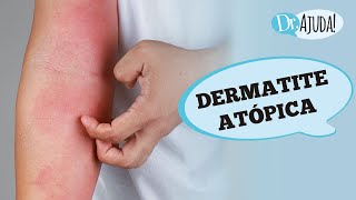 Urticaria Coceira Irritação e Vermelhidão na Pele – Dr Paulo Müller Dermatologista [upl. by Ettedanreb]