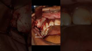 case of infected odontogenic cyst  Surgery  Face surgery  Oral Surgeon surgeon oralsurgeon [upl. by Dodson]