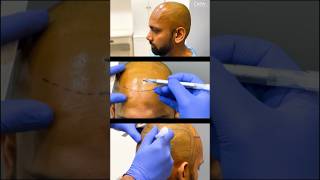 Ideal Hairline in Hair Transplant [upl. by Sherill]