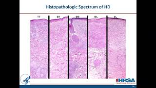 When to Suspect Leprosy Clinical Aspects and Treatment of Uncomplicated Hansens Disease [upl. by Isabeau662]