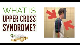 What Is Upper Cross Syndrome [upl. by Uwton]