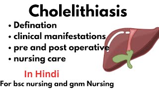 Cholelithiasis [upl. by Rosenzweig]