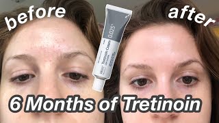 6 Month TretinoinRetinA Update Before amp After  My Current Skincare Routine [upl. by Aicertal]