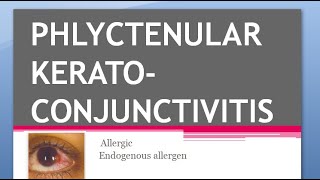 Ophthalmology PHLYCTENULAR KERATOCONJUNCTIVITIS KERATITIS TB Miliary Sacrofulous Fascicular Salzmann [upl. by Gervais]