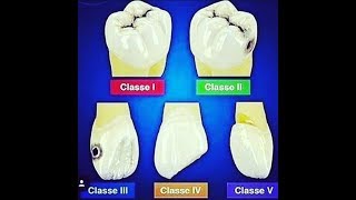 Classification of dental caries [upl. by Aicilec]