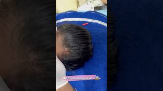 traction Alopecia…😱  shorts youtubeshorts [upl. by Llehcar]