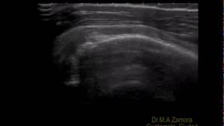 Bursitis subacromiodeltoidea [upl. by Zealand610]