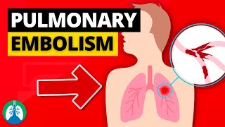 Pulmonary Embolism Medical Definition  Quick Explainer Video [upl. by Anatole570]