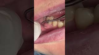 Dental abscess satisfying [upl. by Noyerb481]