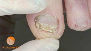 Deep cleaning of thick nails with fungus podologiaintegral [upl. by Weylin]