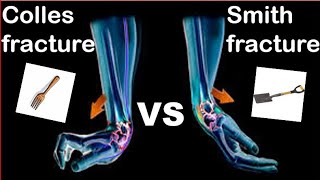 Colles fracture VS Smith fracture [upl. by Teerpnam]