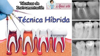 ENDODONCIA  Técnicas de Instrumentación Técnica Híbrida  PARTE 3 [upl. by Jegger840]