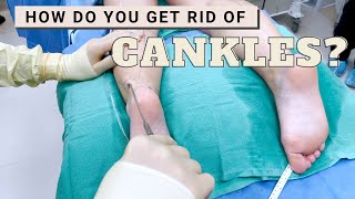 Get Rid of Cankles with High Definition Calf Liposuction  Barrett Plastic Surgery [upl. by Violet]