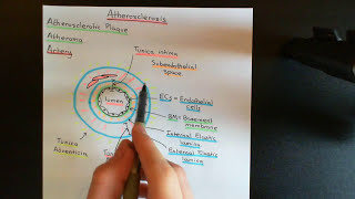 Atherosclerosis Part 1 [upl. by Kirbie]