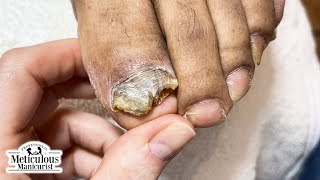 Tips to Treat Nail Fungus at Home [upl. by Zabrina]