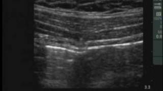 UltrasoundGuided Transversus Abdominis Plane Block [upl. by Camp]