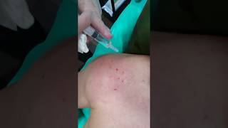 Mesoterapia en tendinopatía del hombro [upl. by Assyli]