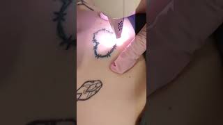 Tattoo verwijdering met Yag laser [upl. by Ayikin]