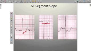 Effects of Ischemia on the ECG [upl. by Adnarym691]