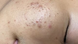 ACNE TREATMENT VU QUYNH MI Blackheads On Boy Face 2024 [upl. by Uzzia]