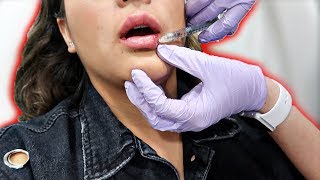 LIP INJECTION EXPERIENCE Live footage [upl. by Acinoed]