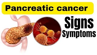 Pancreatic cancer symptoms in Hindi  Symptoms of pancreas cancer [upl. by Yelime]