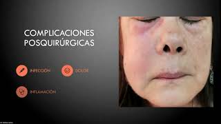 Alveolitis Complicación más frecuente en la tercera molar [upl. by Oribelle246]