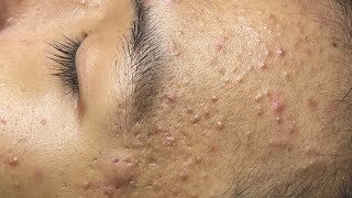 ACNE TREATMENT VU QUYNH MI Acne On Teens Cheek 2024 [upl. by Hillel874]