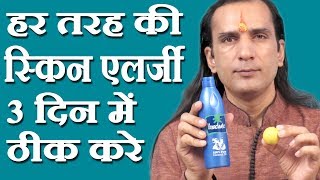 स्किन एलर्जी का घरेलू नुस्खा How To Cure Skin Allergy  skin allergy treatment at home Sachin Goyal [upl. by Belsky]