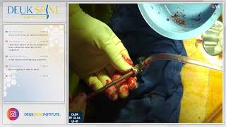 Endoscopic Debridement of Spinal Infection w Fusion  L3L4 L5S1 [upl. by Notlew]