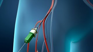 Coronary Angioplasty Femoral Access [upl. by Odnaloy]