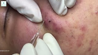 Big Cystic Acne Blackheads Extraction Blackheads amp Milia Whiteheads Removal Pimple Popping [upl. by Aufmann]