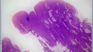 PATHOLOGY SLIDES 6 DR SAMEH GHAZY [upl. by Stevy786]