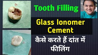 Tooth Filling Glass Ionomer Cement  GIC Restoration  GIC filling [upl. by Aihsia927]