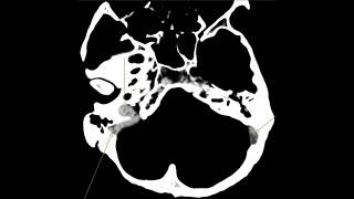 Venus Sinus Thrombosis and Intraventricular haemorrhage  CT CT angiogram and Venogram [upl. by Javier]