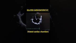 Dilated Cardiomyopathycardiomyopathymyocarditisechoheartfailure heartfunctionpericarditis [upl. by Llertnek715]