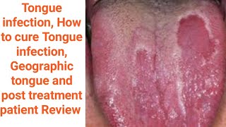 Geographic tongue Tongue infection Mouth inside infection benign migratory glossitis causes amp Tt [upl. by Aekal]