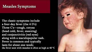 Measles  Symptoms Treatment and Complications Red rush [upl. by Aridnere661]