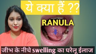 Below tongue swellingsalivary gland stonesialothiasistreatment of RANULA जीभ के नीचे swelling [upl. by Huesman]