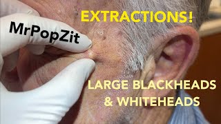 Awesome acne extractions Some solar comedones Favre some regular blackheads and whiteheads [upl. by Celene]