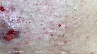 Big Cystic Acne Blackheads Extraction Blackheads amp Milia Whiteheads Removal Pimple Popping [upl. by Nohsauq88]